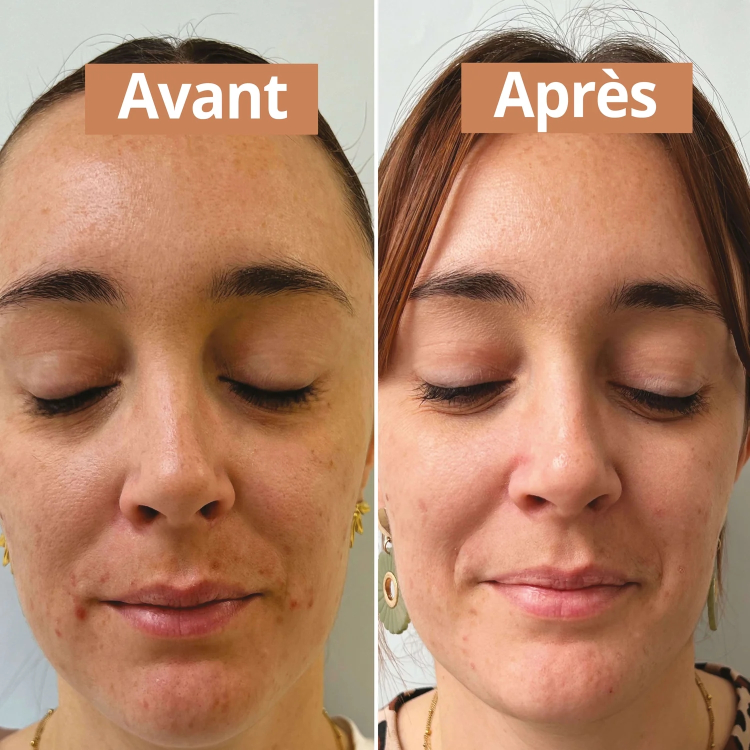 Amélioration visible de la peau après soin purifiant